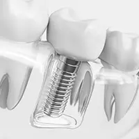 Model of dental implant