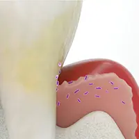 Model of gum line